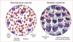 04252023-multiple-myeloma-thanh-mai